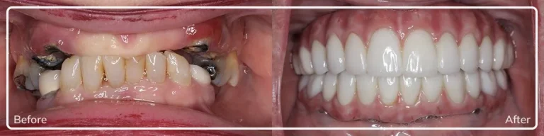 IEOMFS-Zygomatic-Implants-2-e1678323835482 copy